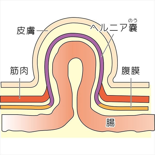 鼠径ヘルニア｜東京都港区・千代田区・中央区で鼠径ヘルニアの治療なら汐留みらいクリニック