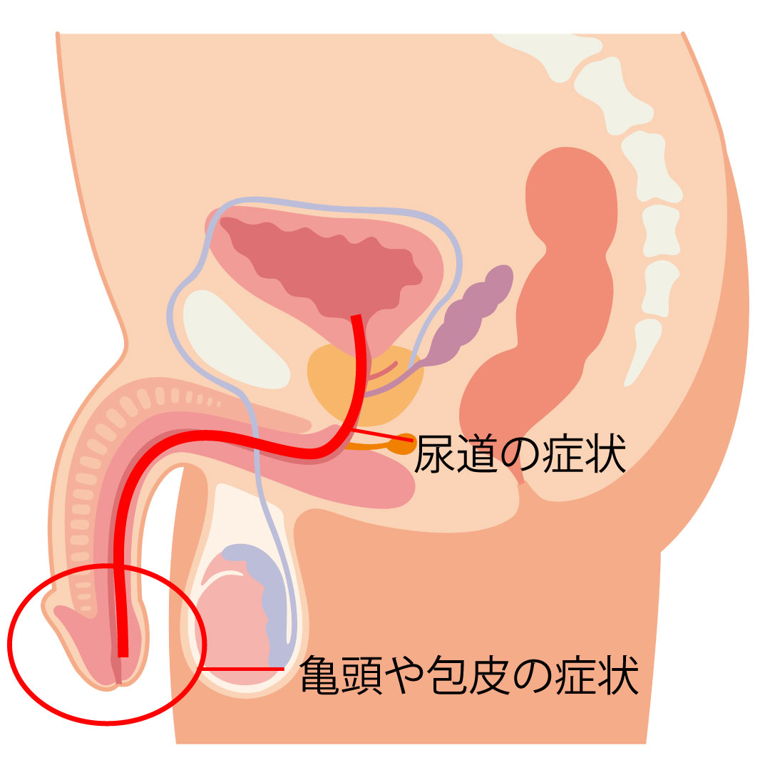 泌尿器科専門医 ドクター尾上の医療ブログ: クンニによるHIVの罹患について