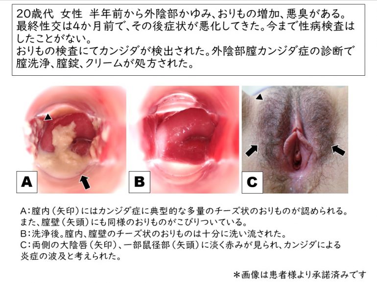 これって、性感染症？｜HIV検査・相談マップ