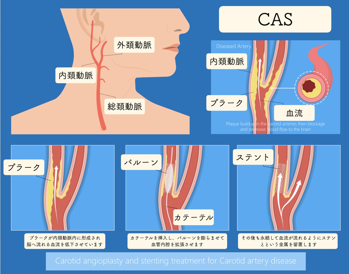 内科的脳梗塞診療の基本を押さえる。 | Antaa Slide