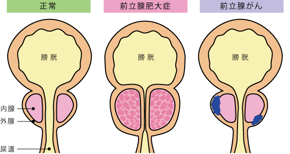 前立腺マッサージは医療行為！？泌尿器科医が解説