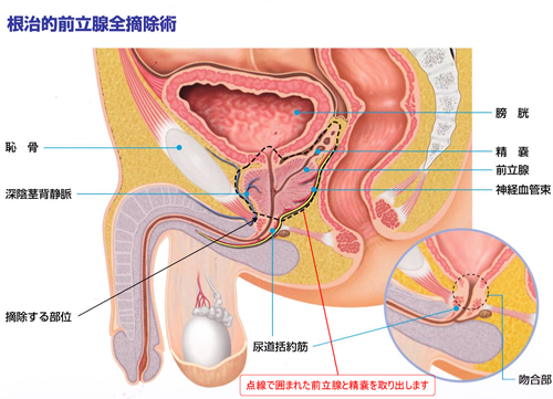 前立腺肥大症 | 北海道泌尿器科記念病院