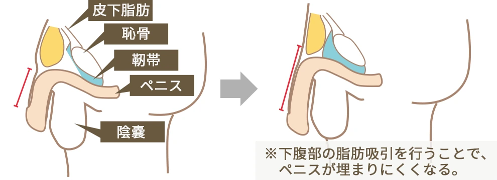 亀頭を確実に大きくする方法とは？ペニトレや増大器具の効果は？ | 包茎手術のノーストクリニック【公式】