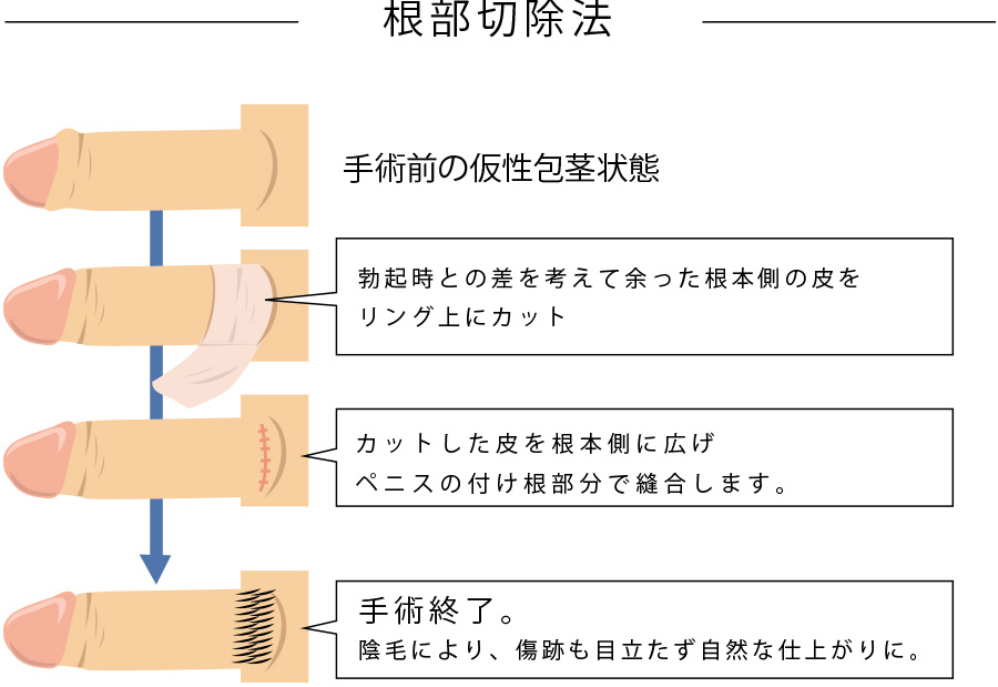 泌尿器科専門医が解説】医学的に安全で効果的なペニス増大法とは