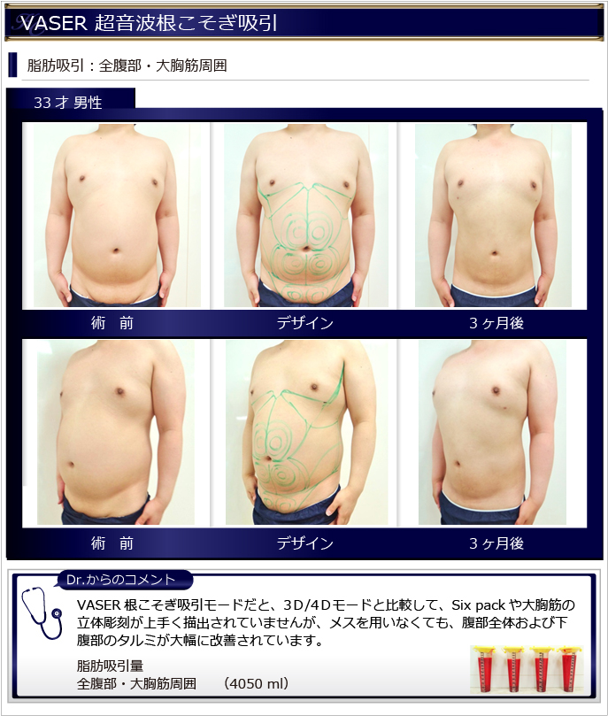 男性の脂肪吸引｜メンズ美容整形外科なら湘南美容クリニック【公式】