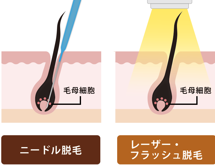 毛抜きでヒゲを抜くと生えなくなる？｜髭の自己処理方法の比較とヒゲをなくす方法 | エピステ