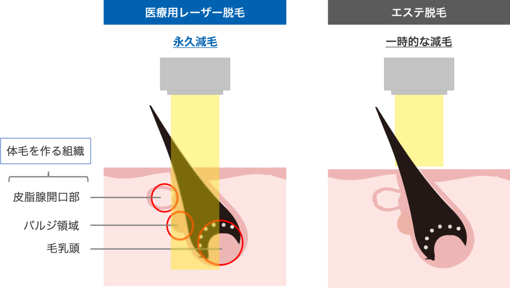 Iラインのメンズ脱毛｜メンズ脱毛専門店RINX(リンクス)