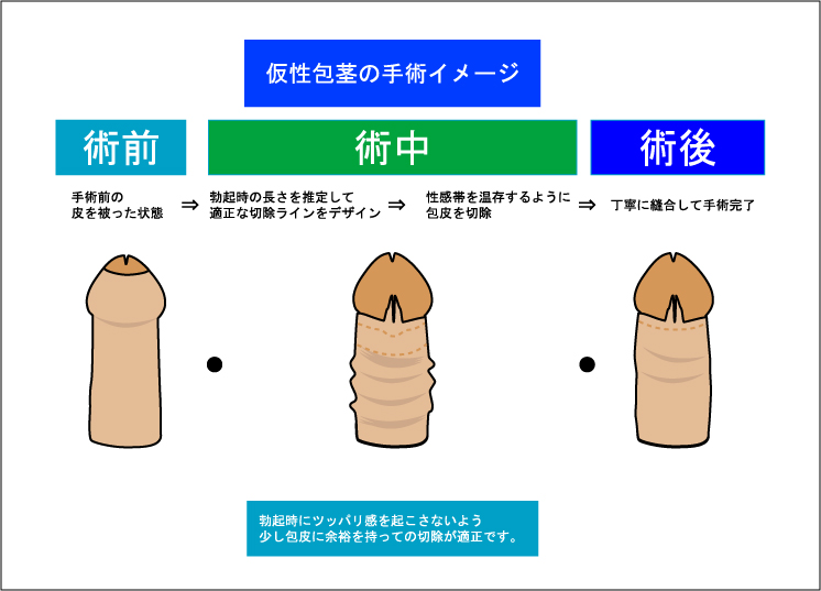 泌尿器科の専門医が解説】仮性包茎の手術で知っておくべき７つの知識