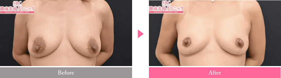 乳輪縮小手術 | 豊胸・バストアップ | 美容整形はTCB東京中央美容外科