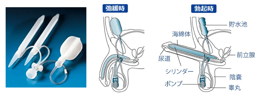 コックリング 仮性包茎矯正 勃起不全 早漏改善 防止