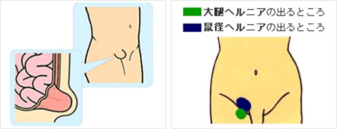 そけいヘルニア（脱腸）｜全国土木建築国民健康保険組合 総合病院 厚生中央病院