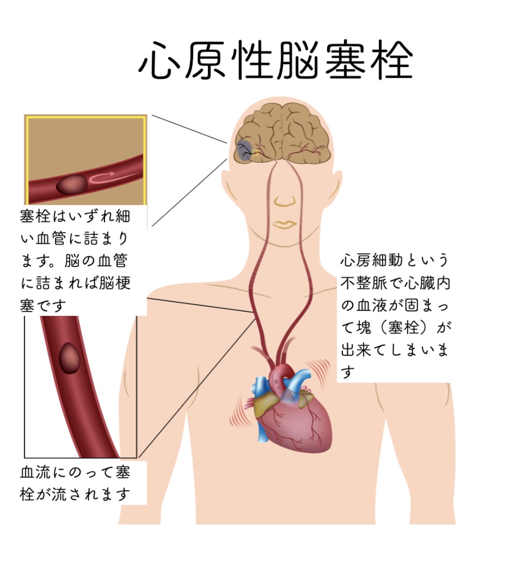 脳血管性認知症ー予防と治療ー | 脳疾患を知る | 桑名眼科脳神経クリニック