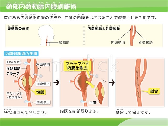 頚動脈をぐっと押さえるといいです。」 / 人ハモ さんのイラスト