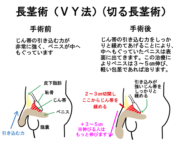 陰茎増大(サオを太く長く) | ペニス増大